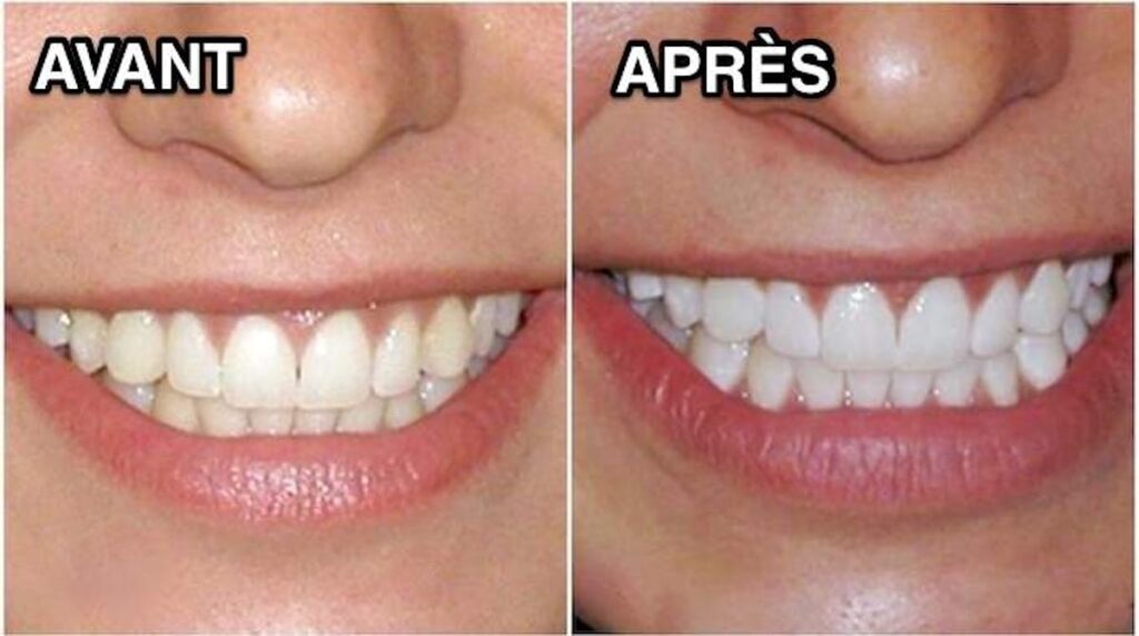 Comment avoir de nouveau les dents blanches ?