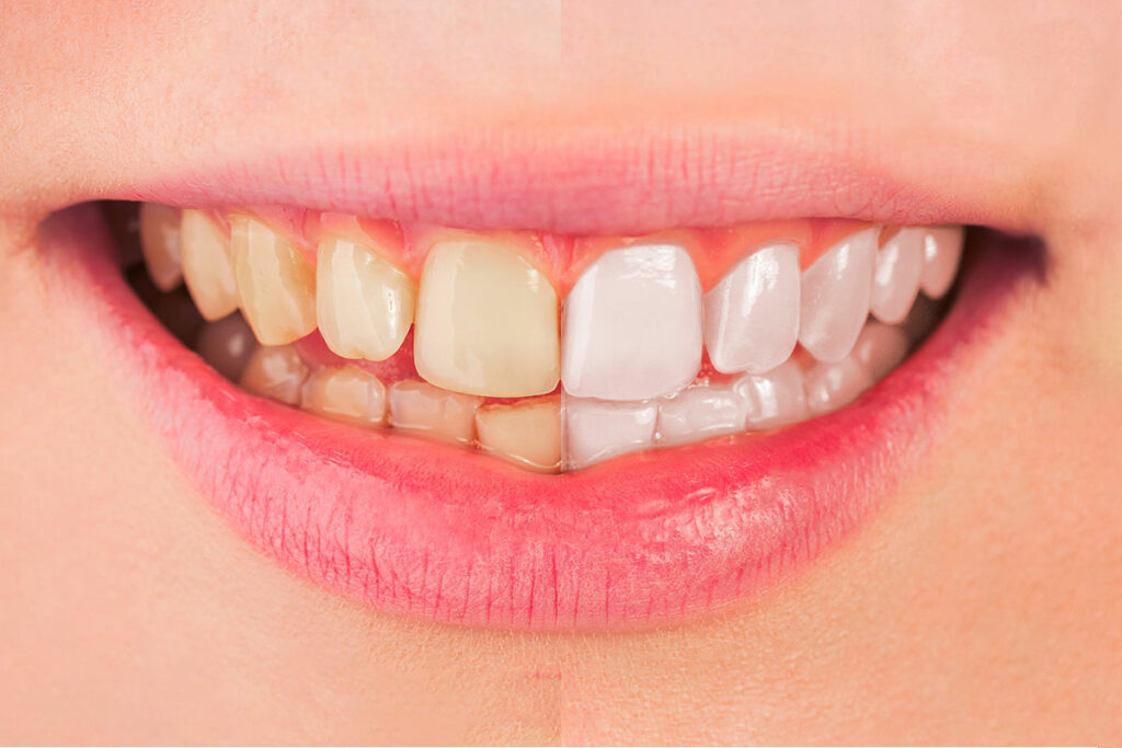 Comment blanchir les dents dans Photoshop ?