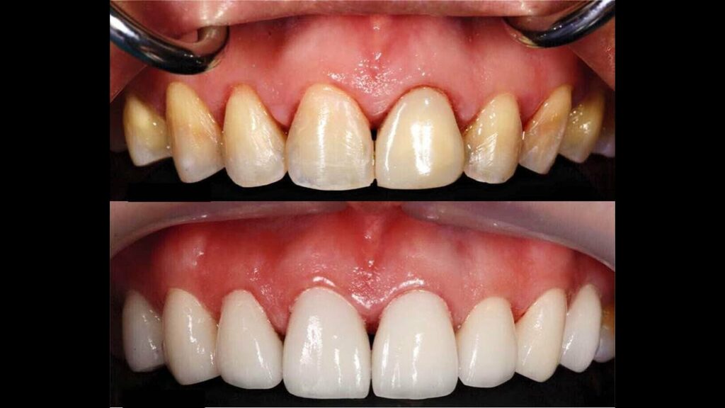 Comment blanchir les dents en photo ?