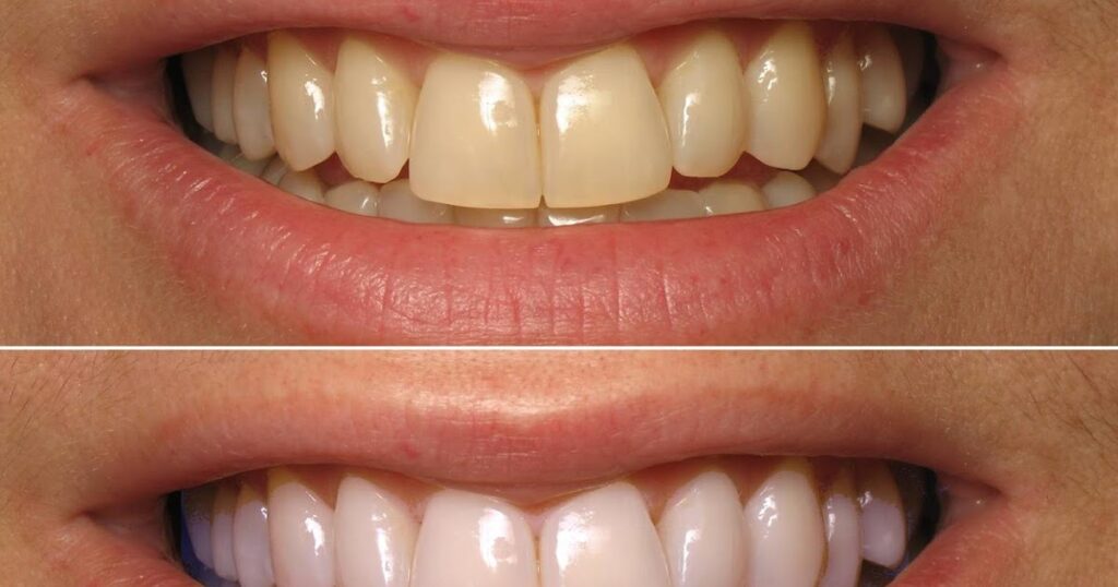 Comment faire pour blanchir les dents sur une photo ?