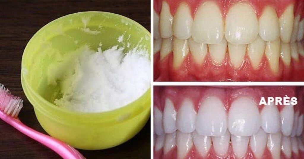 Quel application pour blanchir les dents ?