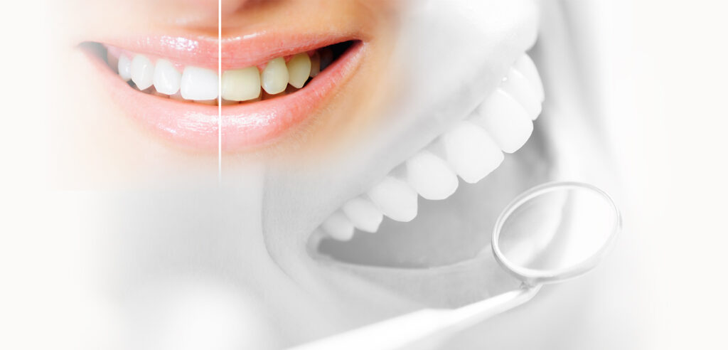 Quelle est la durée d'un blanchiment dentaire ?
